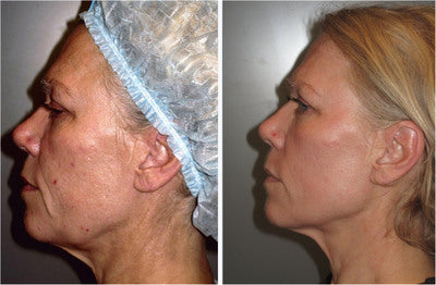 3 traitements Radio Fréquences Visage