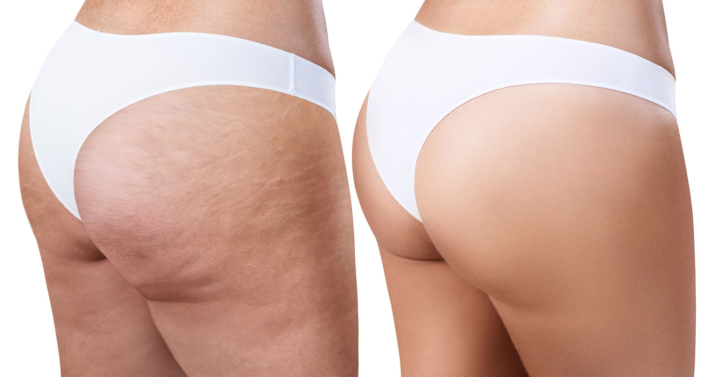 Traitement de Cellulite